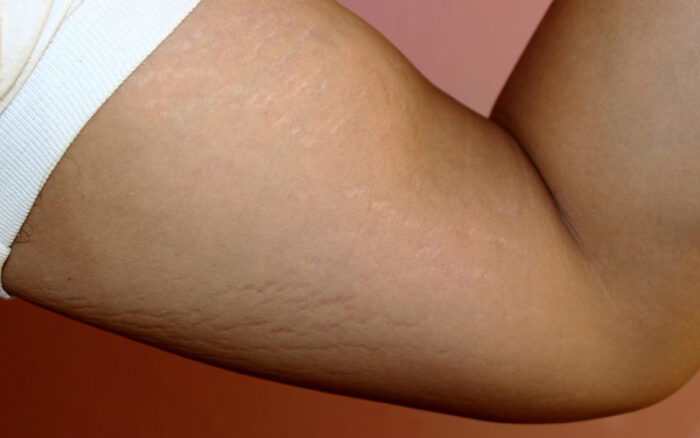 خداحافظی با ترک‌ها و خطوط پوستی بعد از لاغری  کاهش وزن