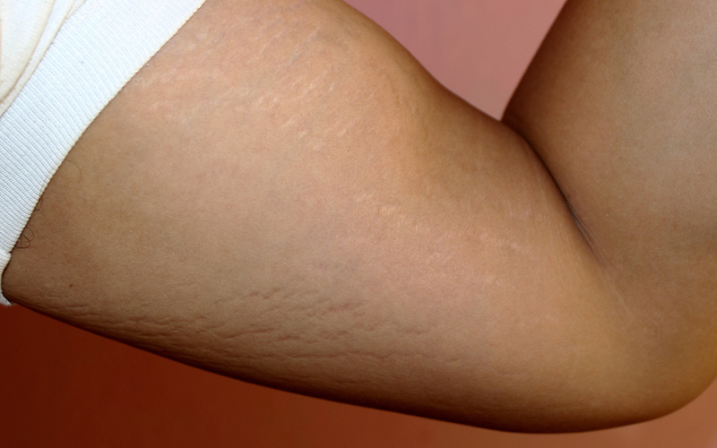 استریا |‌ ترک پوستی