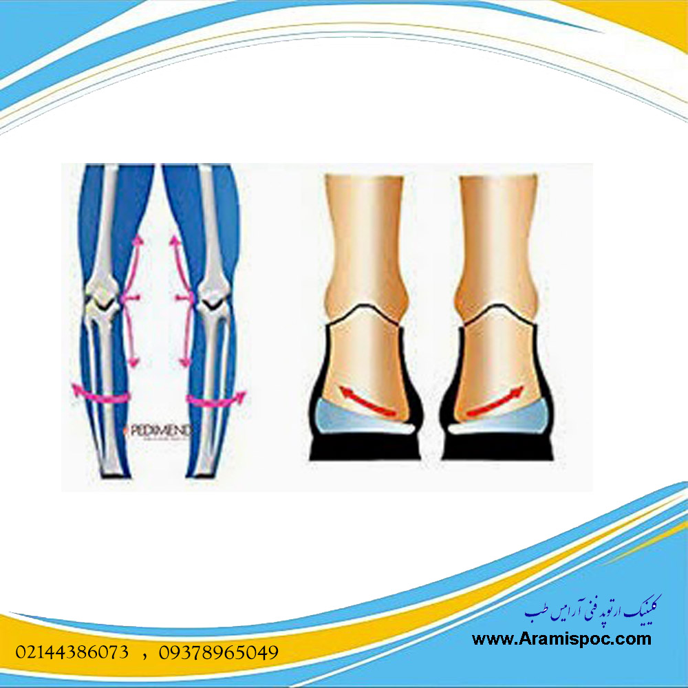 روش درمان زانوی پرانتزی کودکان